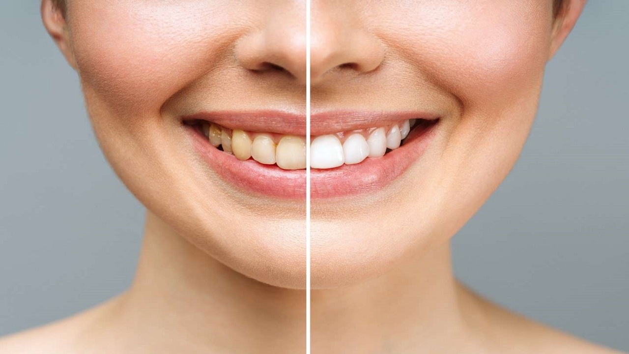 Experts Guide on How to Use Teeth Whitening Strips